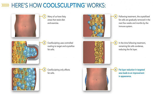 Best CoolSculpting Clinic Orlando FL - PrimeraBodyDesigns